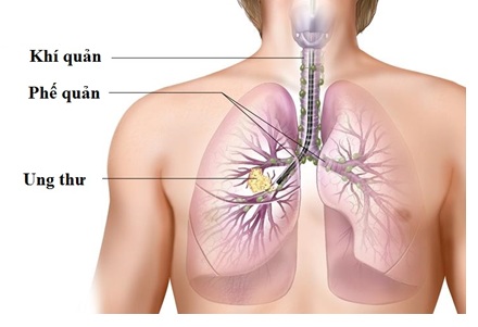 Tầm soát ung thư phổi